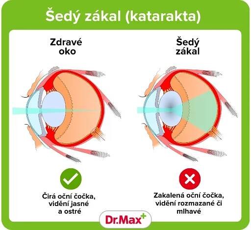 Šedý zákal – příznaky, léčba a operace | Dr. Max