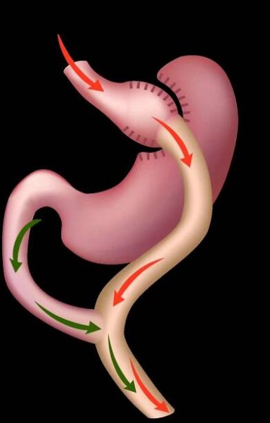Bariatric Surgery
