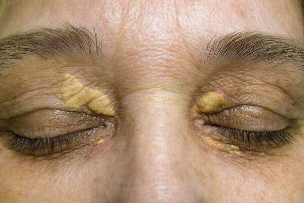 Cholesterol Deposits Under Eyes Removal