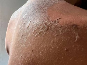 Peel back and shoulder skin from sunburn effect on young man body from sunbathing in summer — Stock obrázek