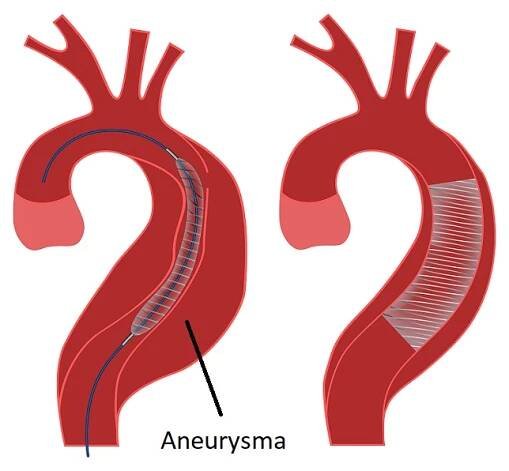 Stentgraft - aneurysma aorty