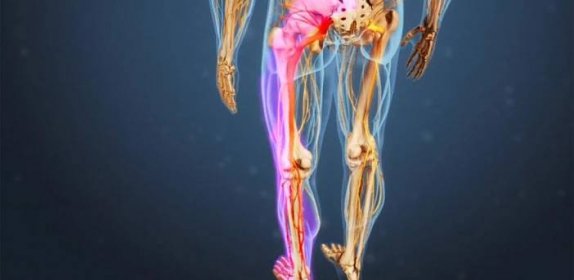 Přiskřípnutý nerv vydává nohu