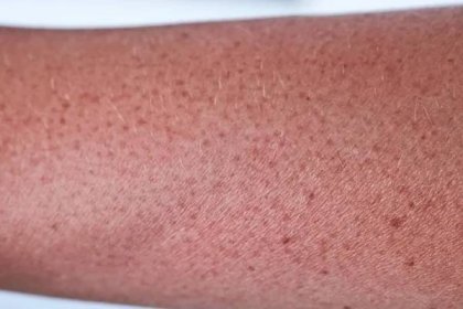 Ruka Spálila Slunci Zčervenalá Kůže Ženské Ruky Detailní Záběr Spálení — Stock fotografie