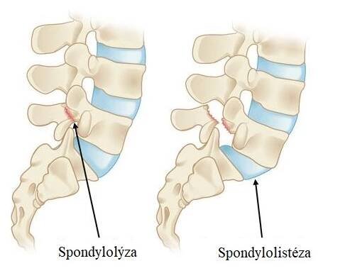 Spondylolistéza - co je to - příznaky, příčiny a léčba - cviky, které pomáhají