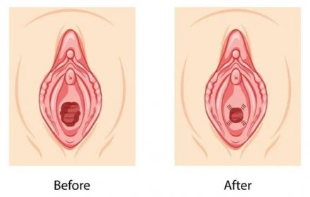 Hymenoplasty before and after Hymen repair restoration revirginization reproductive system uterus. Front view. Human Surface anatomy of perineum external organs scheme, vagina vulva flat style icon — Ilustrace