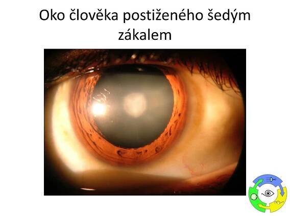 PPT - Oční vady PowerPoint Presentation, free download - ID:5957842