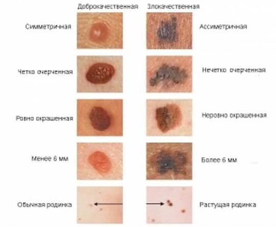 Jaké kožní léze naznačují maligní melanom? / Články | Užitečné informace a tipy na péči o sebe. Zdraví, výživa a další.