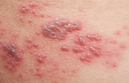 Příznaky herpes zoster