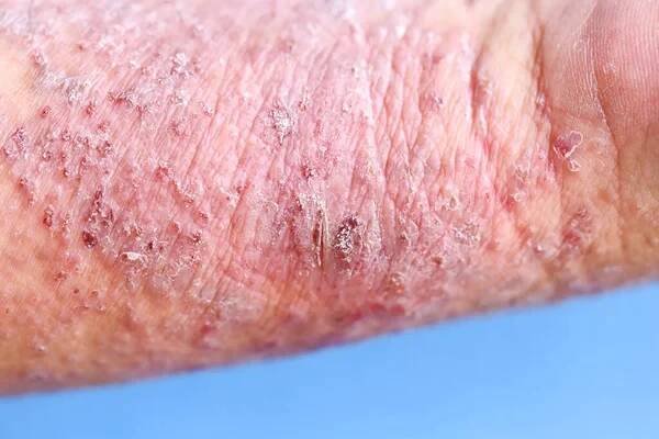 Atopická dermatitida (AD), také známý jako atopický ekzém, je typ zánětu kůže (dermatitida). — Stock obrázek