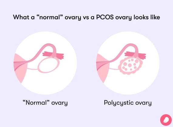 A PCOS ovary vs a normal ovary