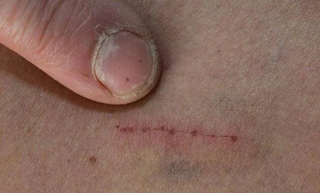 Tajuplný syndrom Morgellons. Když lidé vidí v kůži parazity - AAzdraví.cz