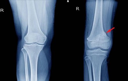 Distal Femur (Knee) Cartilage Injury Treatment Chillicothe, OH | Dr Cohen