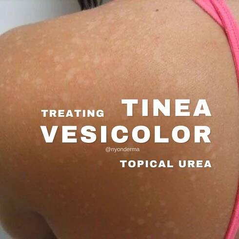 Topical Urea Treatment For Tinea Versicolor: An Effective Approach - Nyon Derma