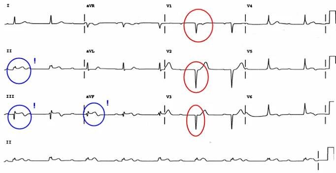 Jizva myokardu - EKG | Medicína, nemoci, studium na 1. LF UK