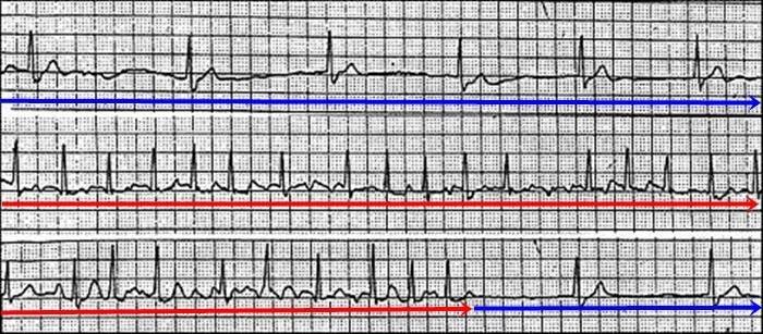 Sick sinus syndrom - EKG | Medicína, nemoci, studium na 1. LF UK