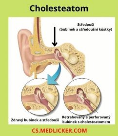 Cholesteatom nejčastěji vzniká při poškození bubínku (perforací nebo rupturou) a projevuje se zejména chronickým výtokem čiré tekutiny z ucha a postupným zhoršováním sluchu.