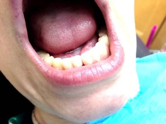 Dental Bonding