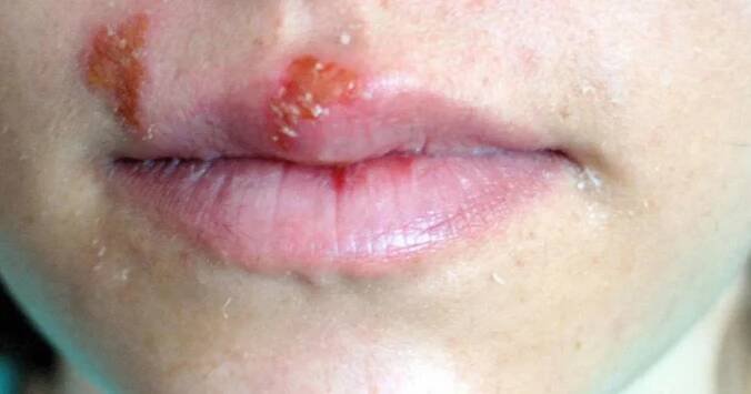 Herpes se může objevit i na noze: 6 tipů našich babiček, jak se tohoto bolestivého a otravného nepřítele zbavit