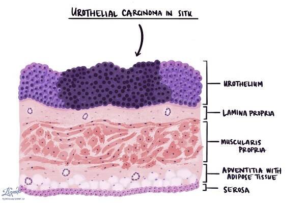 Uroteliální karcinom in situ (CIS)