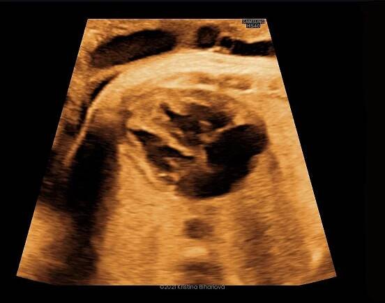 3D sonografia / 3D ultrazvuk - Druhý trimester - Srdce