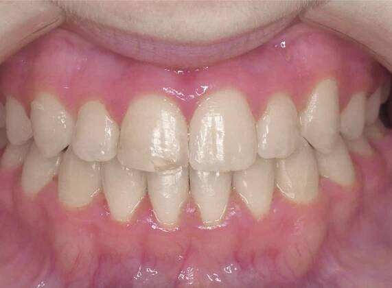 Smile Gallery - Zaytoun Orthodontics