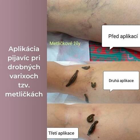 Pijavice lékařské a produktová řada Živa jako dvojka pomocníků. Křečové žíly po aplikaci této terapie mají tendenci ustoupit.