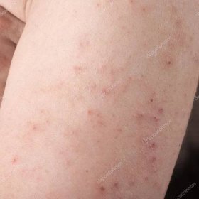Alergická vyrážka dermatitida — Stock Fotografie © librakv #10766042