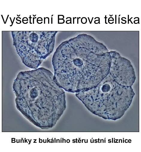 Vyšetření Barrova tělíska Buňky z bukálního stěru ústní sliznice 