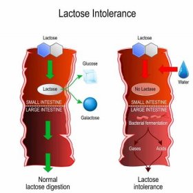 krev ve stolici při intoleranci na laktozu