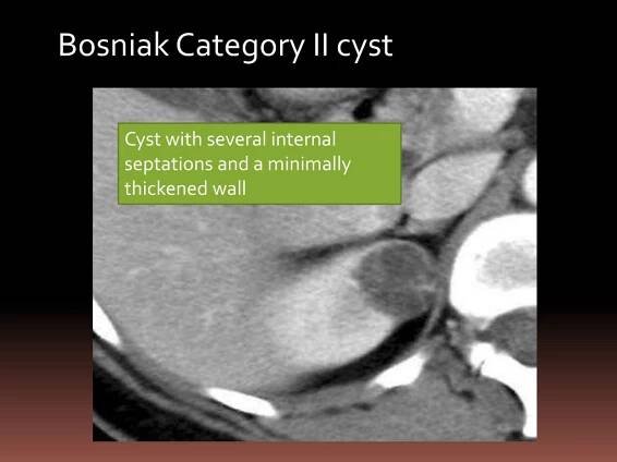 PPT - Simple and Complex renal Cysts PowerPoint Presentation, free download - ID:363278