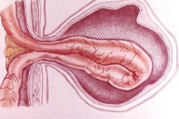 Ventrální kýla (pooperační) / Hernia