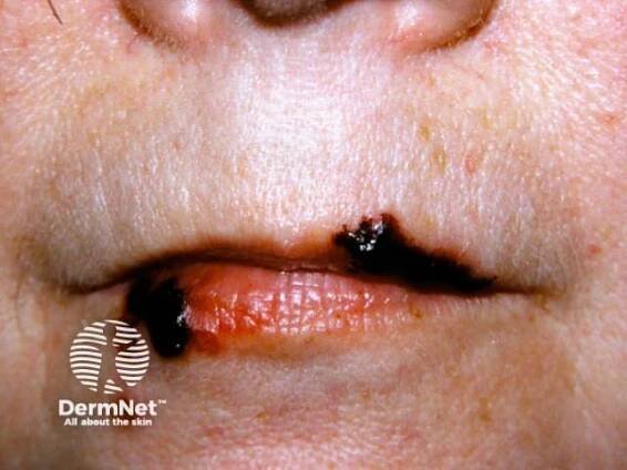 Herpes Simplex Images
