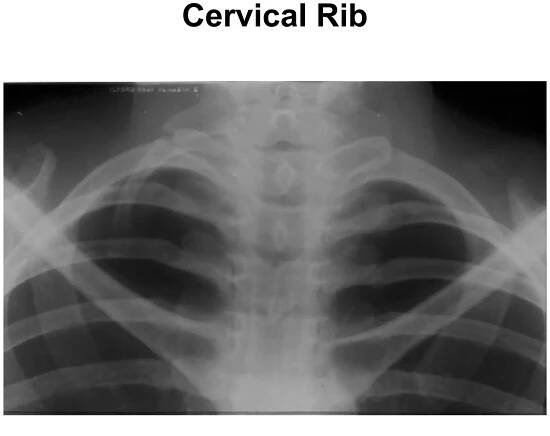 Cervical Rib
 