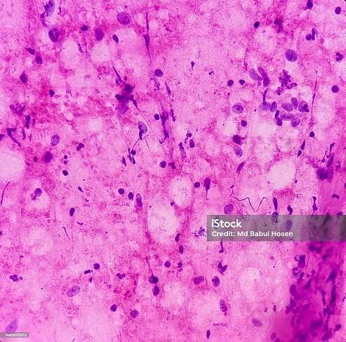 Neurofibromatózy. Neurofibrom (FNA cytologie), mikroskopický obraz ukazuje vřetenovité buňky s vlnitými jádry. Genetické poruchy s tvorbou nádorů v nervovém systému. - Bez autorských poplatků Neurofibromatóza Stock fotka