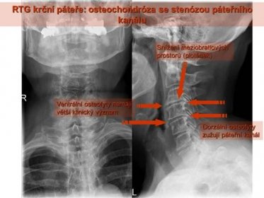Snížení meziobratlových. prostorů (plotének) Ventrální osteofyty nemají. větší klinický význam. Dorzální osteofyty. zužují páteřní kanál.