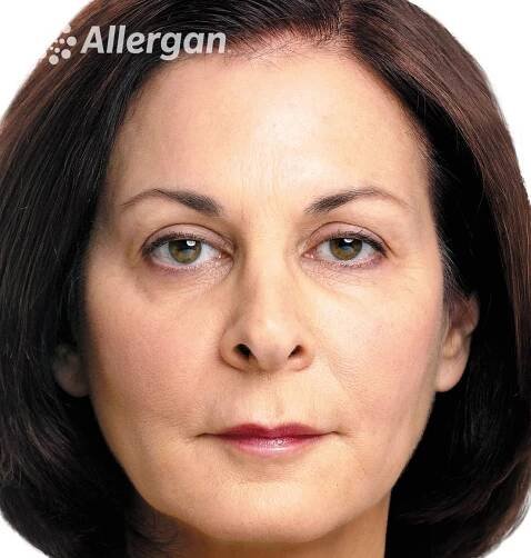 Biostimolazione - Dr. Isola