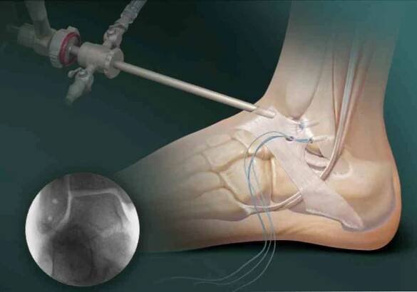 Osteoartróza v oblasti kotníku způsobuje příznaky, léčbu / Artritida | Užitečné informace a tipy na péči o sebe. Zdraví