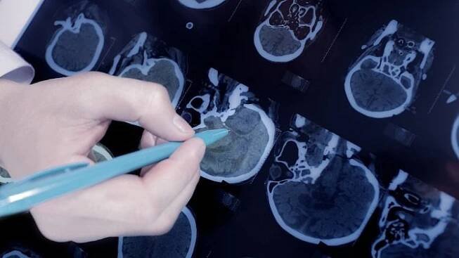 Britští výzkumníci vyvinuli nový test pro diagnostiku mozkových nádorů. Čekání na výsledek zkrátí z týdnů na pouhé hodiny