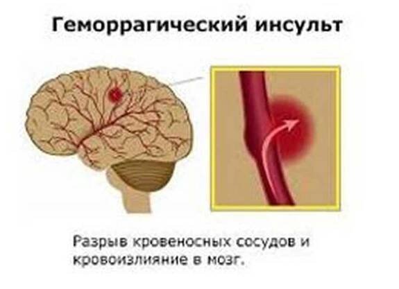 Hemoragická mrtvice / Zdvih