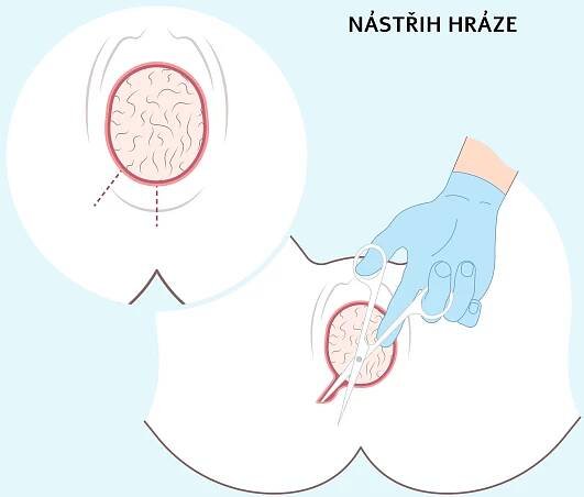 Nástřih hráze - epiziotomie