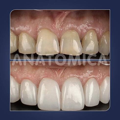 diş_before-after-inst