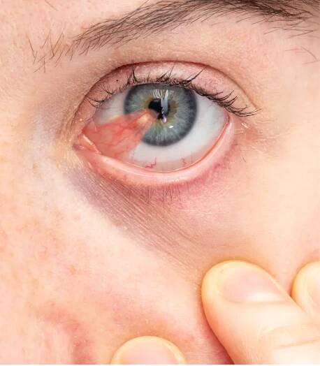 Pterygium Treatment