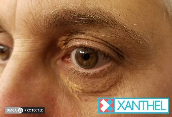 What Does Xanthelasma Look Like