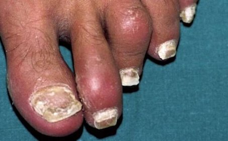 4 nebezpečné mýty o psoriáze nehtů a o tom, jak zjistit správnou diagnózu