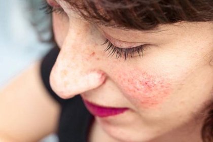 Nepříjemné svědivé pupínky na obličeji možná značí růžovku. Co to je a jak jí léčit?
