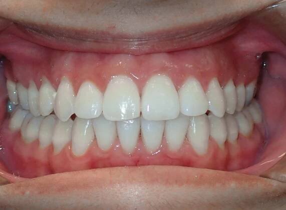 Smile Gallery - Zaytoun Orthodontics