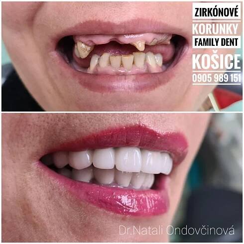 Systém CEREC - Family Dent - Zubná ambulancia Košice