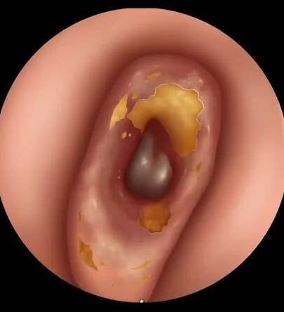 Deep & Stony Hard Earwax Removal Ear Cleaning #makeup #animation #asmr #trendingshorts #viralshorts