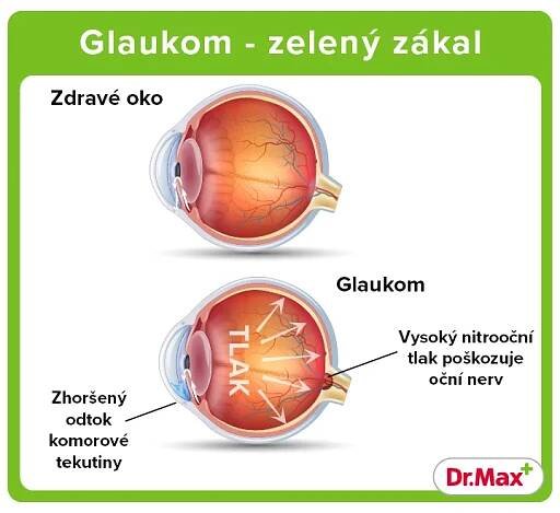 Zelený zákal (glaukom) – příznaky a léčba | Dr. Max