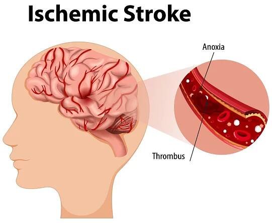 Stroke